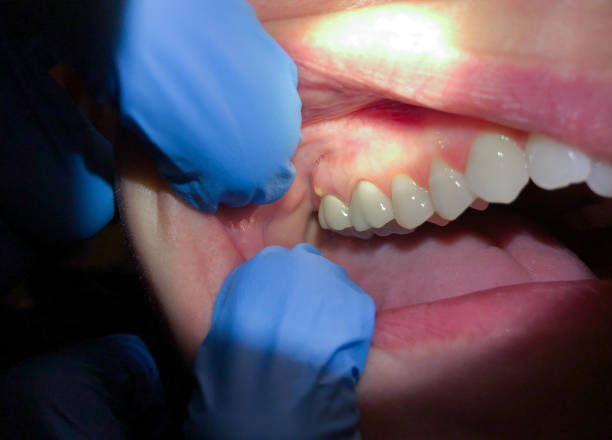 Best Emergency Treatment for Oral Infections in San Pablo, NM